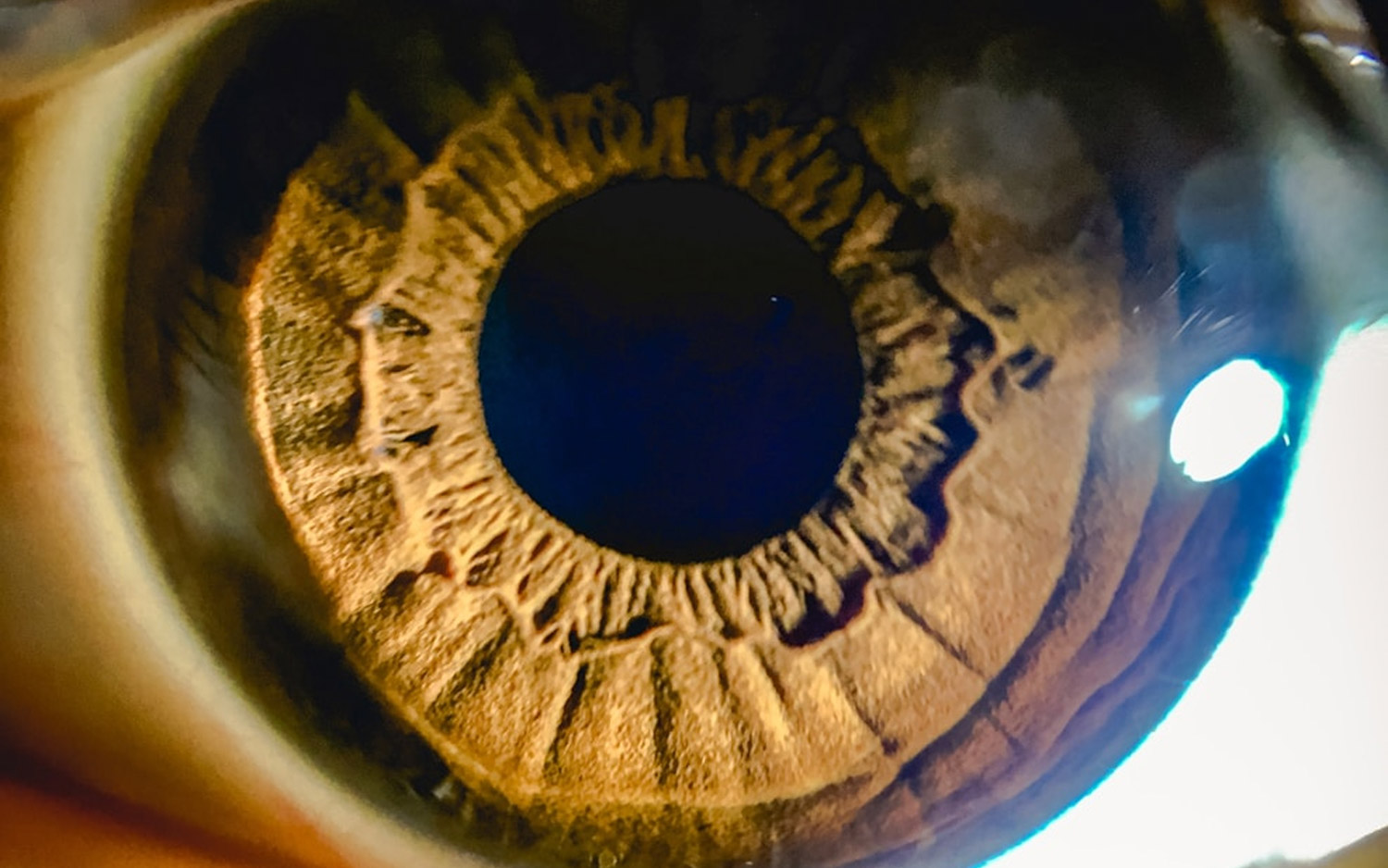 Chabloz opticien notre savoir faire gestion de la myopie